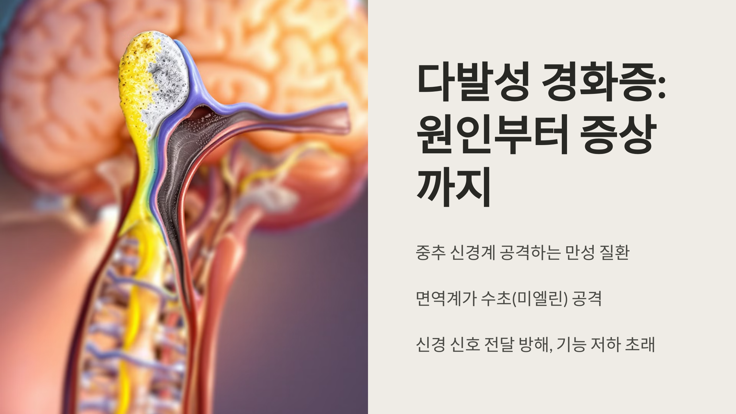 다발성 경화증