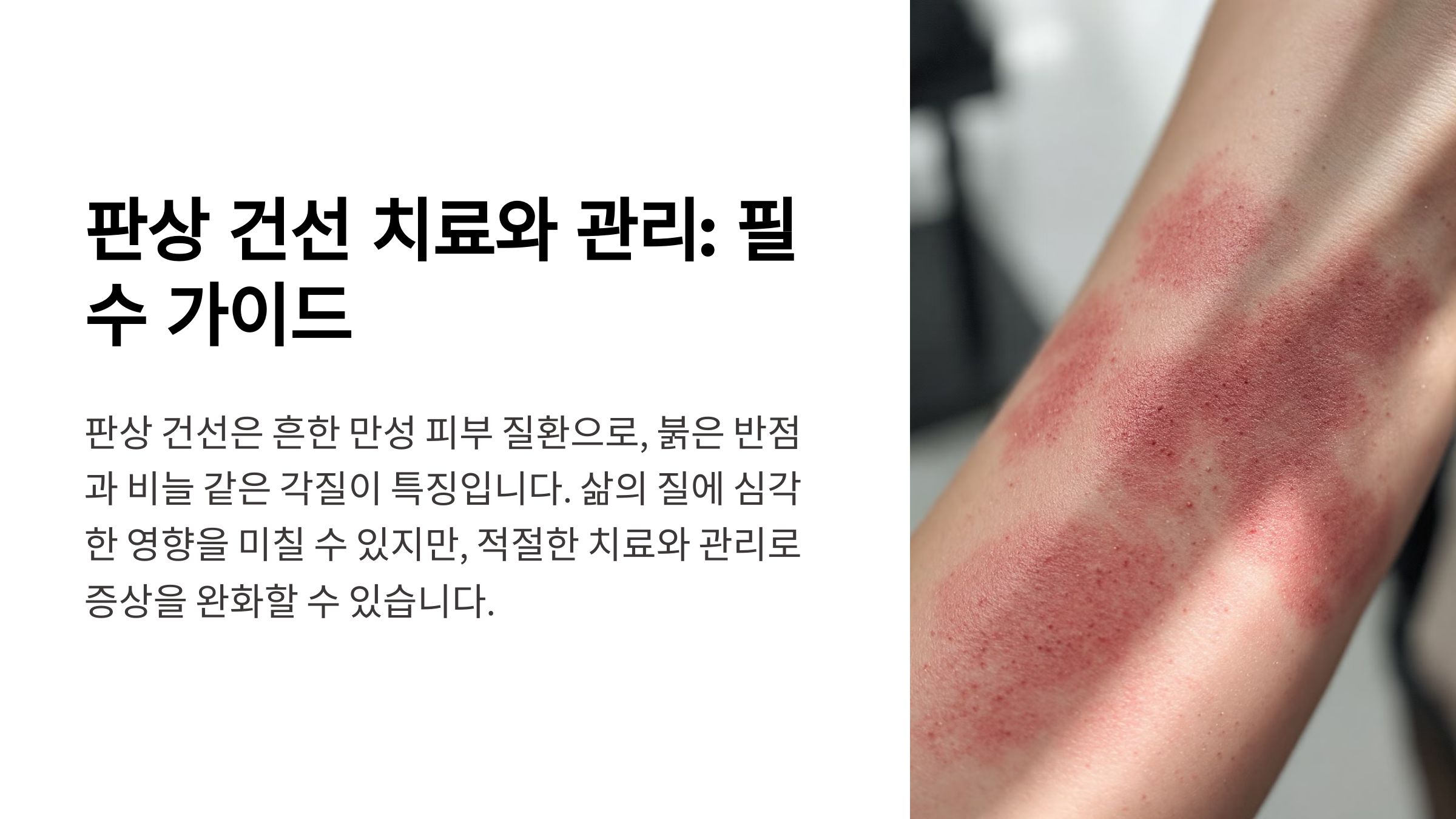 판상 건선