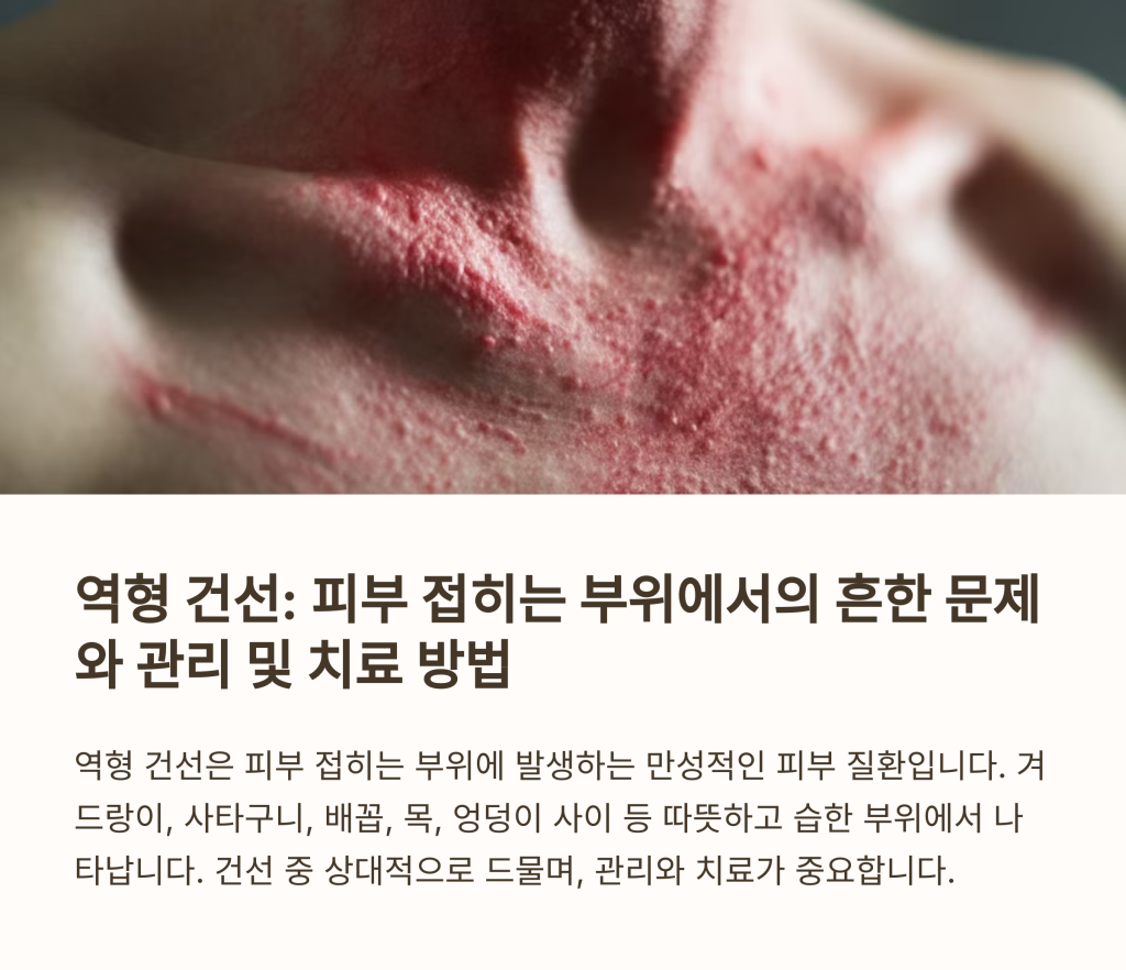 역형 건선