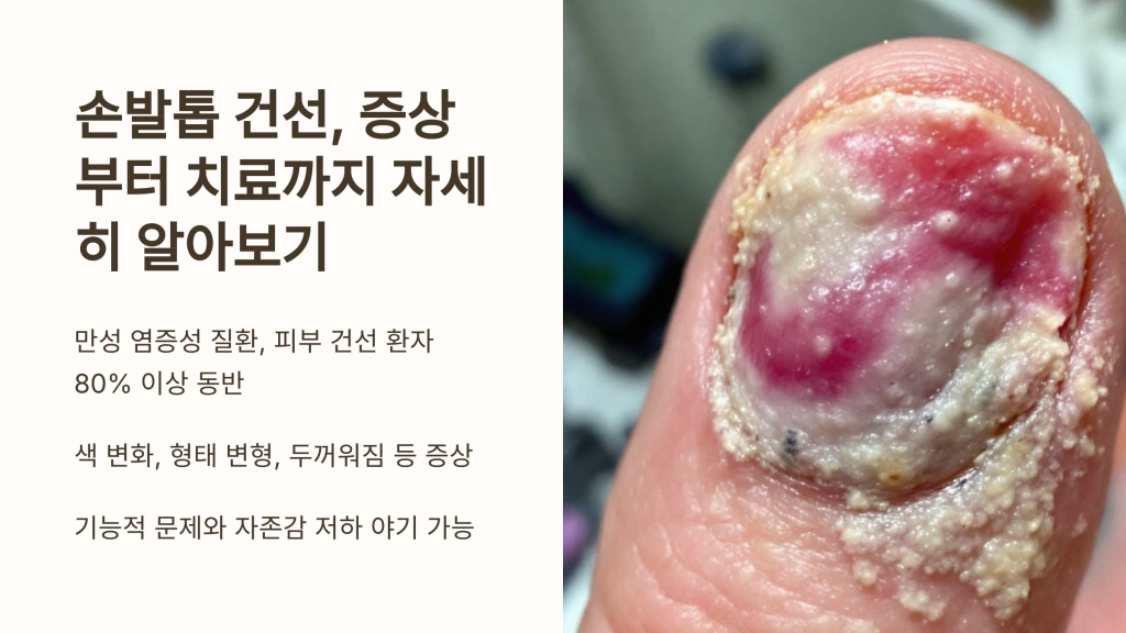 손발톱 건선