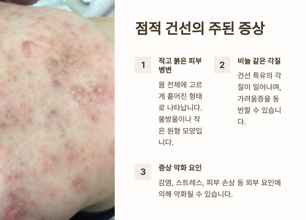 점적 건선