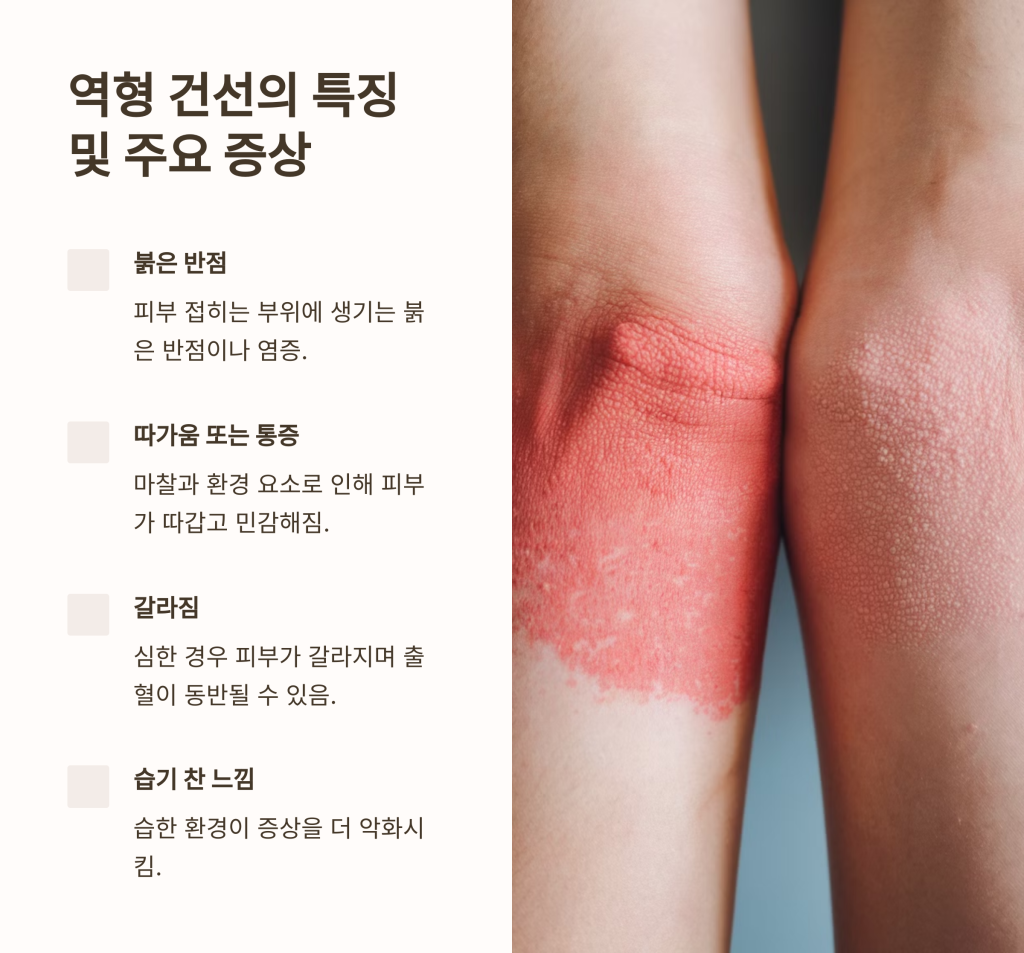 역형 건선