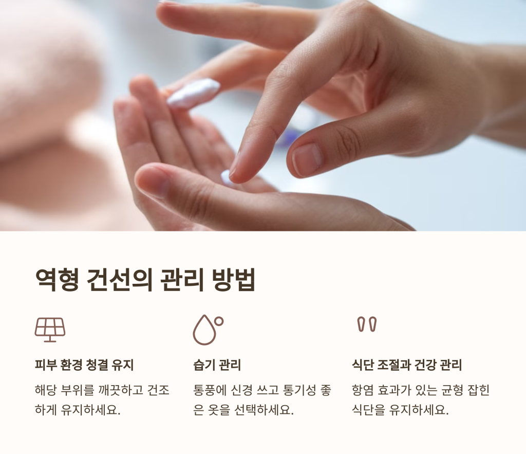 역형 건선