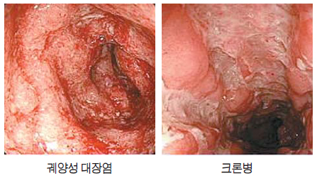 크로병